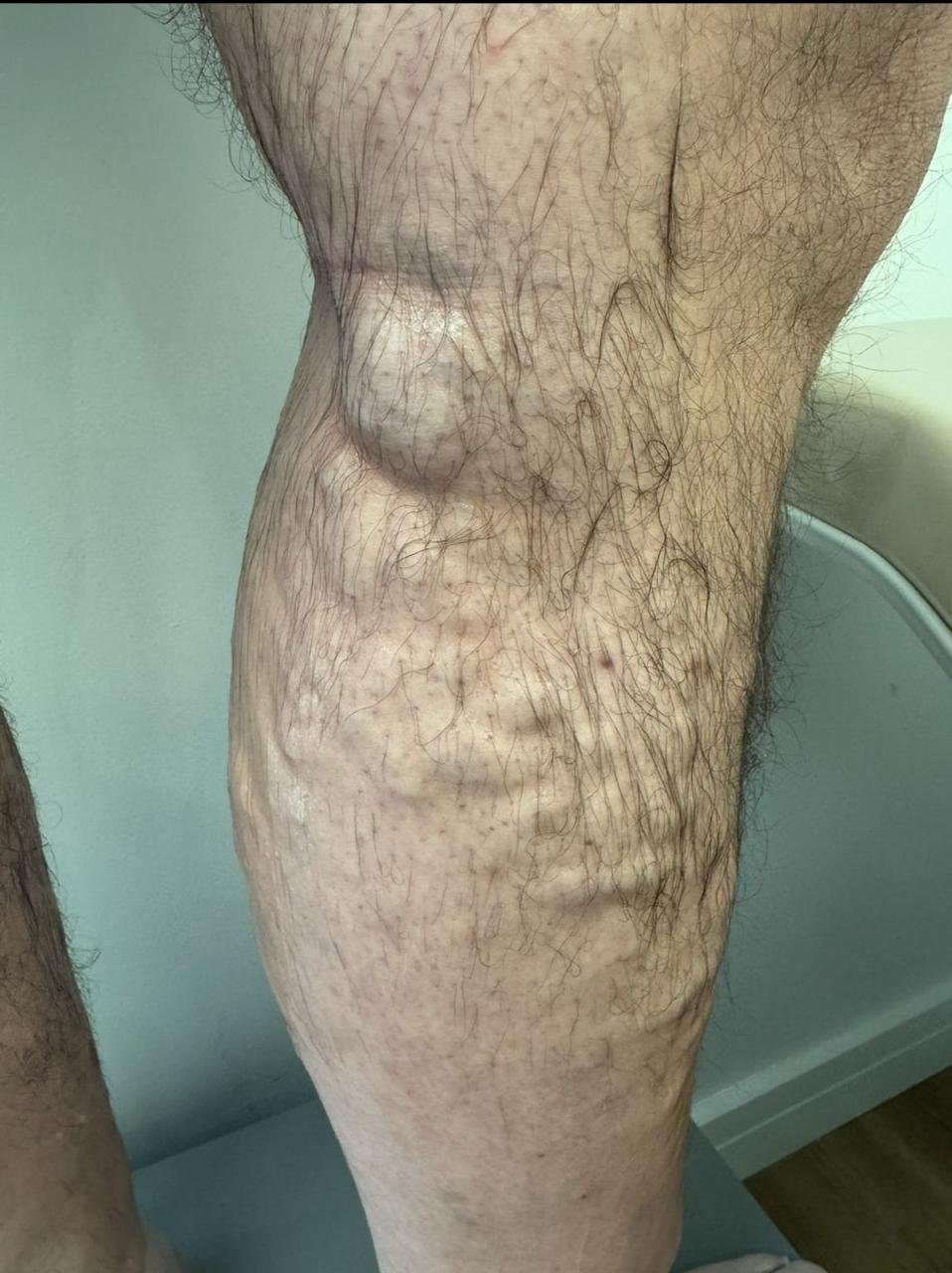 foto de paciente masculino, tratamento para doença venosa, dra. mychelly carvalho