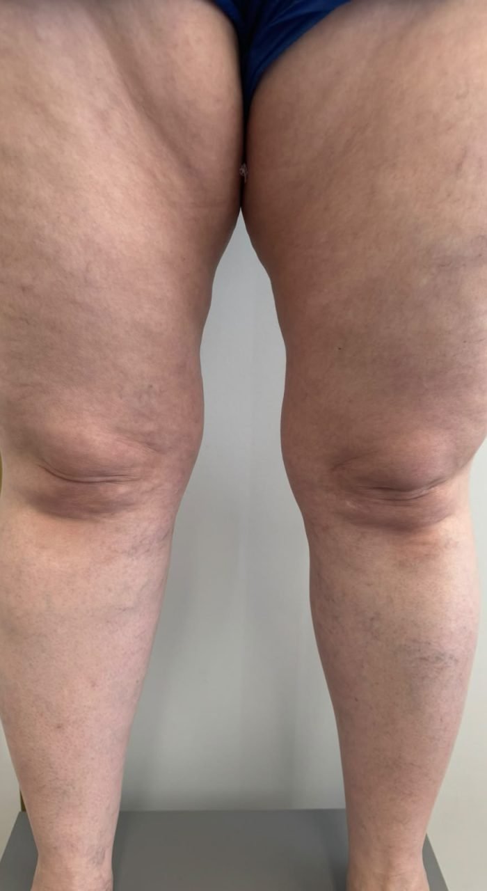 caso para escleroterapia em sp, dra. mychelly carvalho